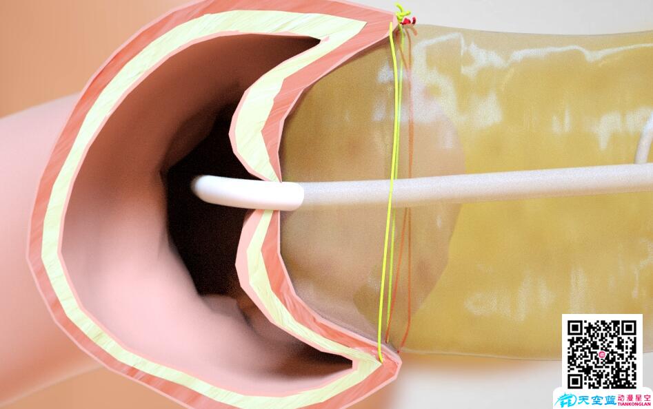 三維3d動(dòng)畫演示胰十二指腸切除術(shù)8.jpg