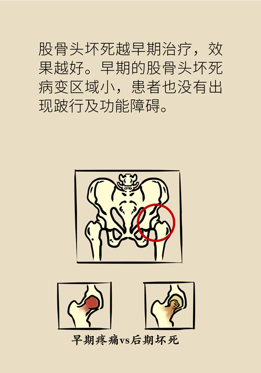 激素會帶來股骨頭壞死的后遺癥嗎？