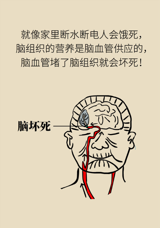 腔隙性腦梗死一定是腦血管堵了嗎？