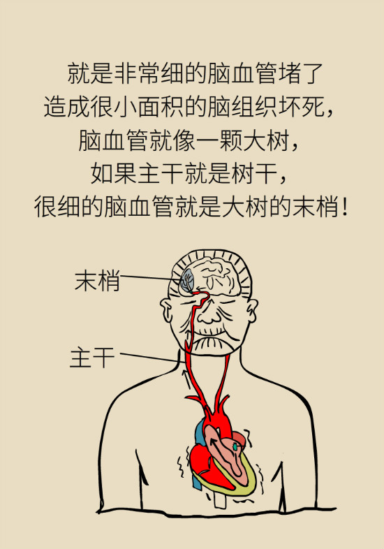 腔隙性腦梗死一定是腦血管堵了嗎？