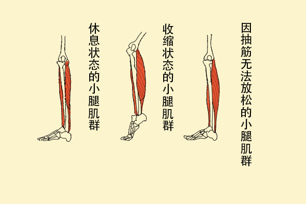 為什么缺鈣會(huì)導(dǎo)致抽筋？