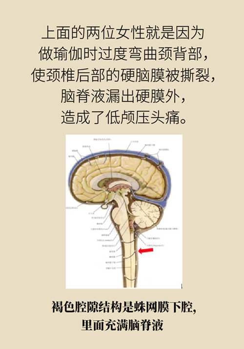 練瑜伽把腦脊液拉漏了！常見(jiàn)的“瑜伽病”你知道多少