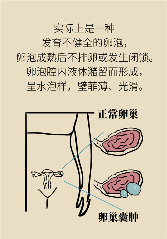 卵巢囊腫科普動漫：卵巢囊腫是腫瘤嗎？要學(xué)會這樣區(qū)分