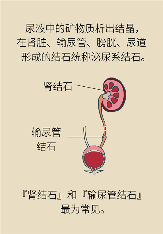 結(jié)石科普：身體里多了各種結(jié)石，應(yīng)該怎么辦？