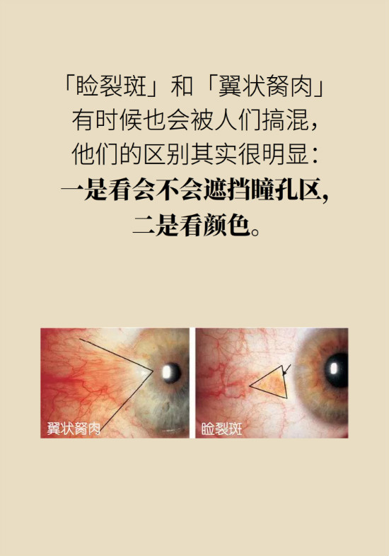 眼白有斑塊、出血要緊嗎？專家：名字唬人但問(wèn)題不大