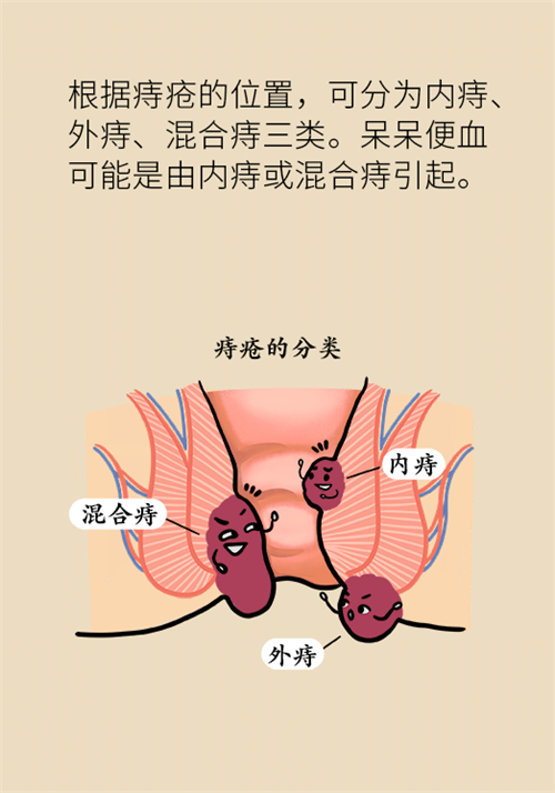 肛門腫脹還有血？小心痔瘡找上門