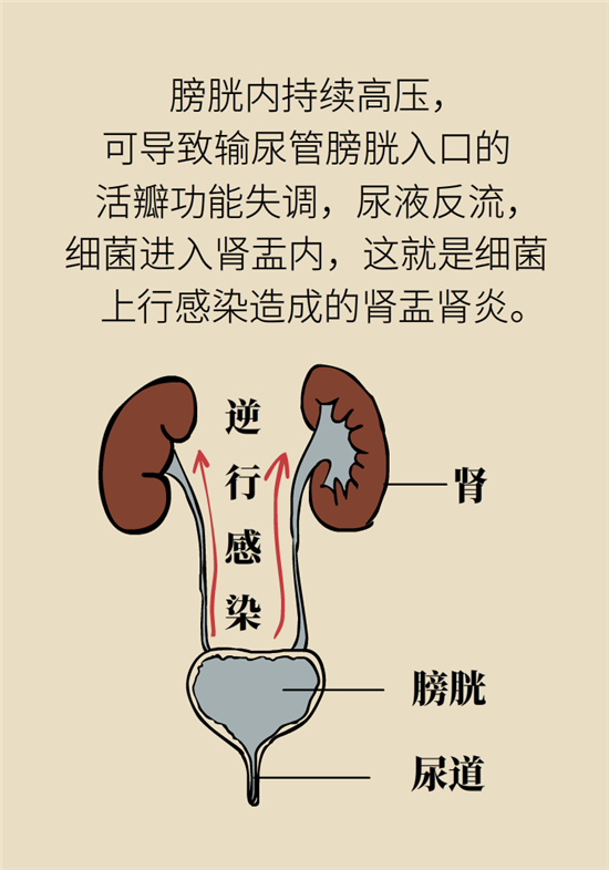 經(jīng)常憋尿會(huì)得急性腎炎？