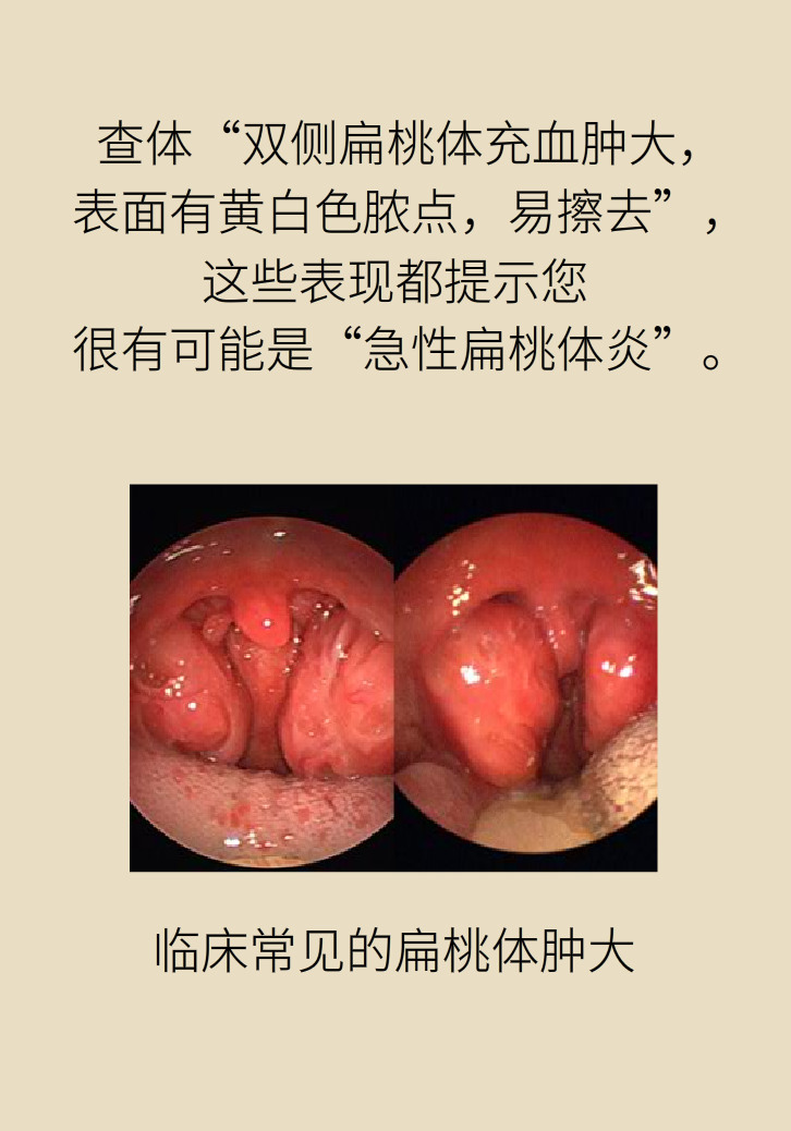 單側(cè)扁桃體腫大更兇險！謹防惡性腫瘤