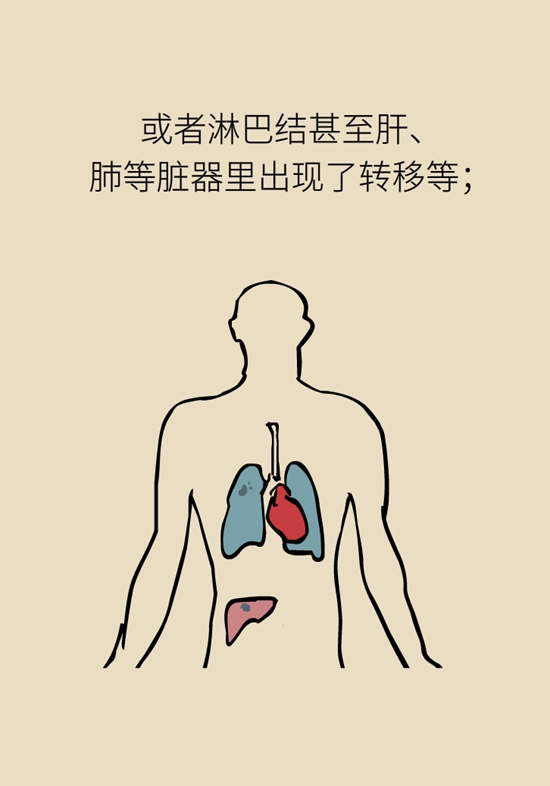 乳腺癌復發(fā)、轉移了怎么辦？