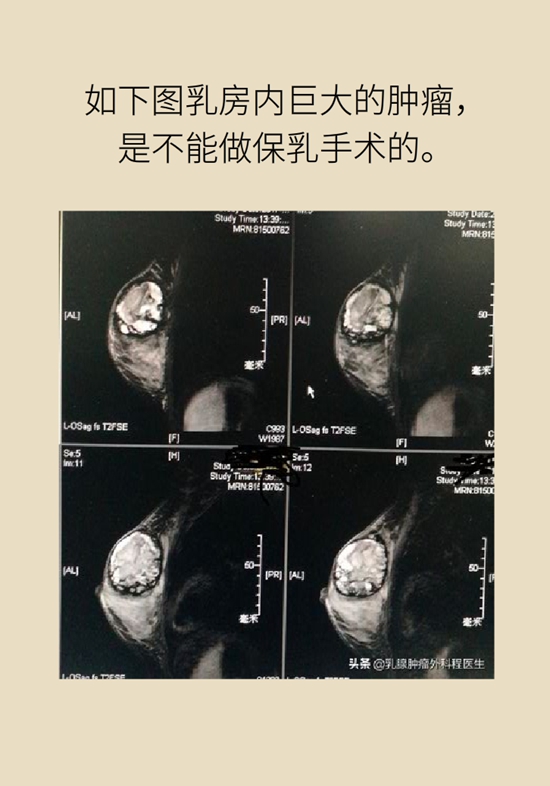 乳腺癌科普動(dòng)漫