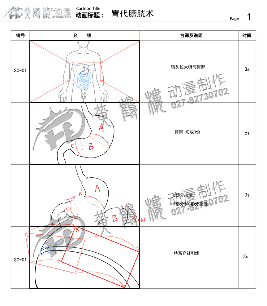 胃代膀胱術(shù)醫(yī)療手術(shù)動(dòng)畫(huà)制作.jpg