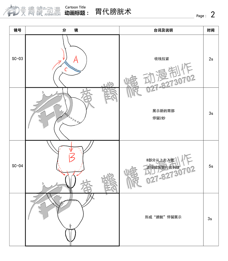 胃代膀胱術(shù)醫(yī)療手術(shù)動(dòng)畫(huà)制作2.jpg