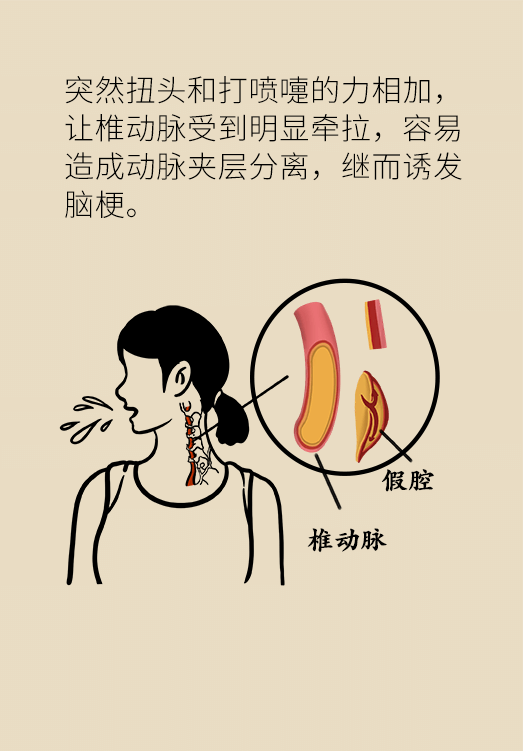 腦梗醫(yī)學(xué)科普動漫設(shè)計